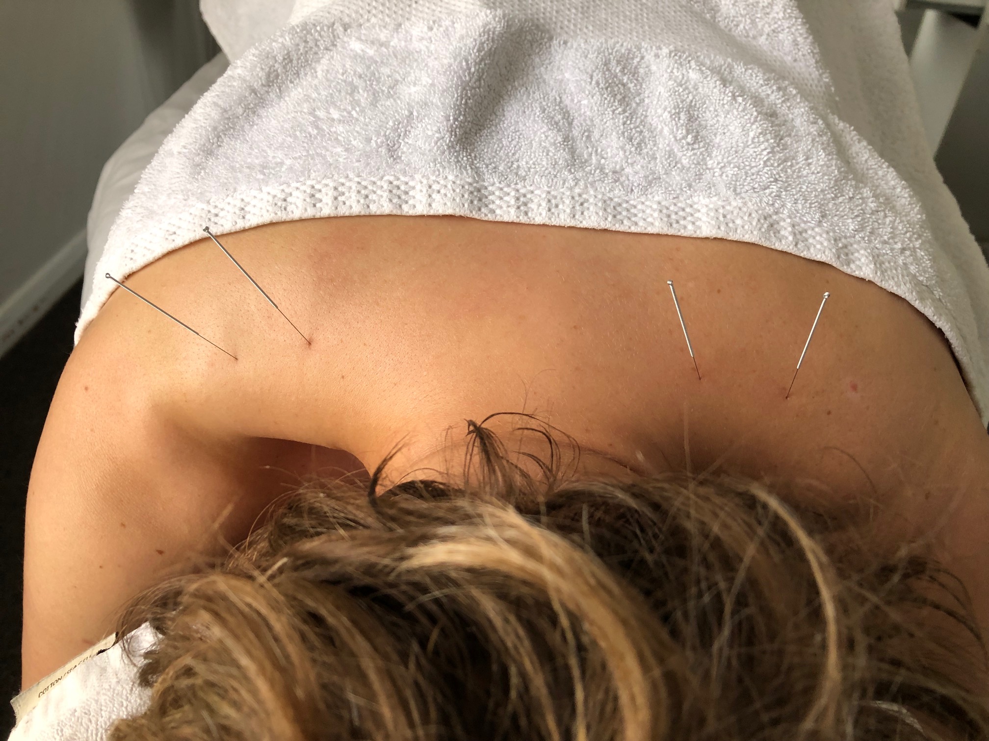 Dry Needling